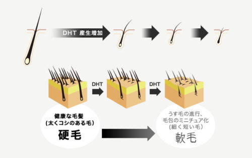 DHTの増加による薄毛の進行